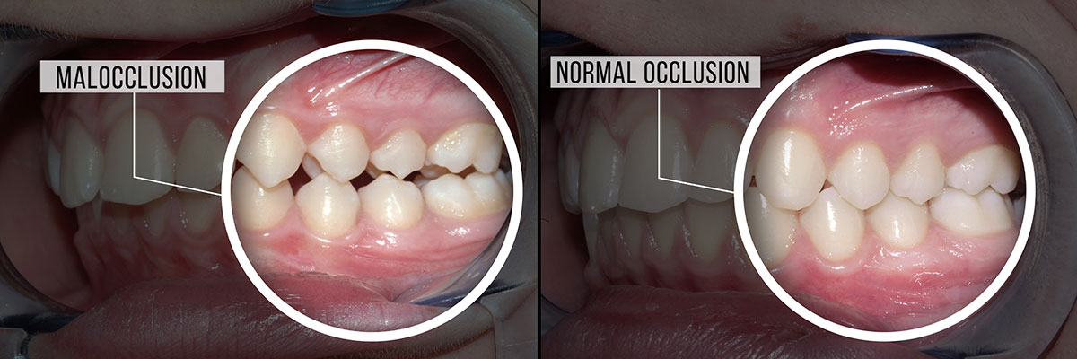 What is a Class 2 Malocclusion?